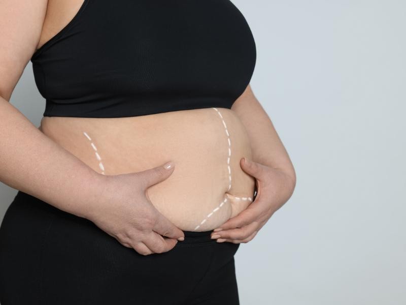 Cirurgia Bariátrica: Cuidados no Pré e Pós-Operatório